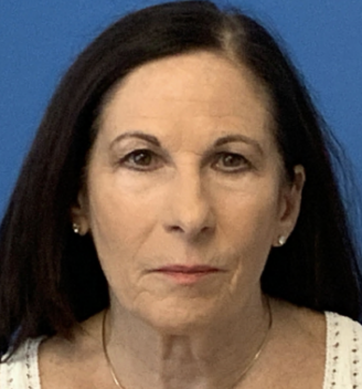 Facial-Rejuvenation---8211--Face-and-Neck-Lift--Upper--amp--Lower-Eyelid-Lift | Before Face